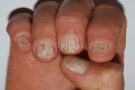 Diseased nails: The best tips for treating them