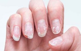 Why are my fake nails peeling off: the main reasons and solutions